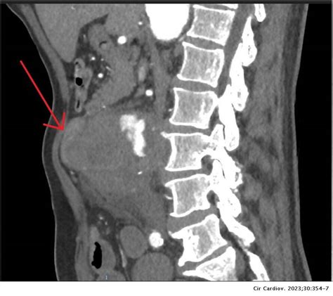 Caso Clínico exitoso Fístula aortoentérica tratada y resuelta con