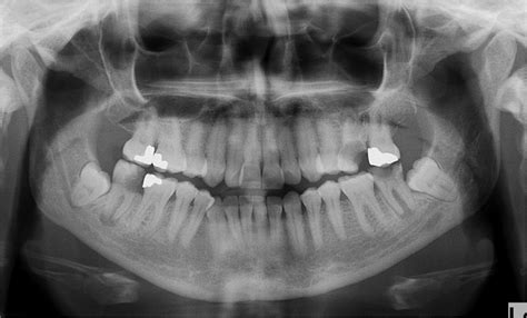 An Oral Lesion As The Primary Clinical Manifestation Of Sarcoidosis The Annals Of The Royal