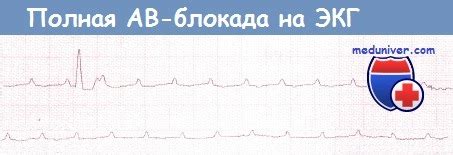 ЭКГ при АВ-блокаде третьей степени