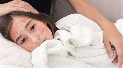 campak gejala penanganan pengobatan pencegahan