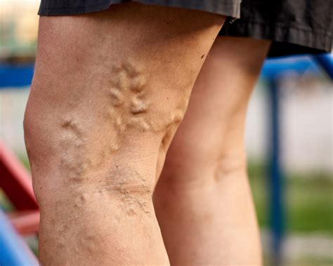 Vein Treatment Specialist 5 Signs Of Vein Problems And Why You Should