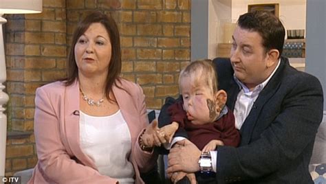 Parents Discover Clove Syndrome Their 4 Year Old Son Was Born With Has