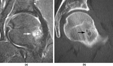 Femoroacetabular Impingement Bone Marrow Oedema Associated With