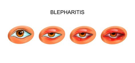 [38+] Blepharitis Causes And Symptoms