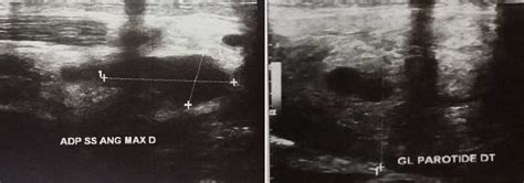 Cervical Ultrasound Showing Inflammatory Angulomaxillary Adenopathy A Download Scientific