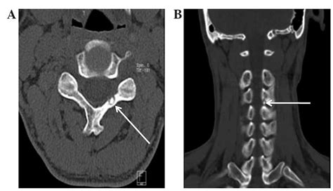 Osteoid Osteoma Femur