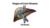 2d Animation Of Stages Of Liver Disease Stock Video - Download Video ...