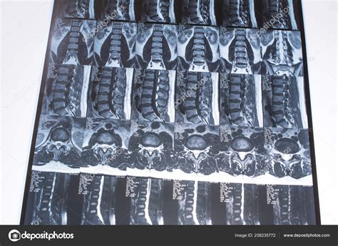 Magnetic Resonance Tomography MRT Of The Lumbar Spine Hernia Stock