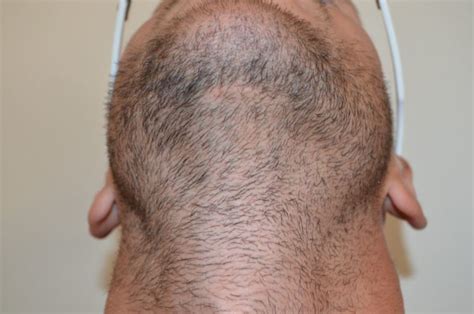 Body Hair Transplant | Hairline Clinic - Body Hair Experts