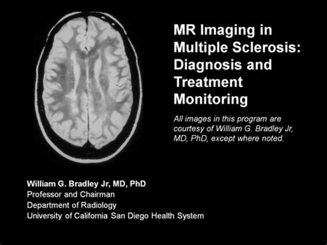 Mr Imaging In Multiple Sclerosis Diagnosis And Treatment Monitoring