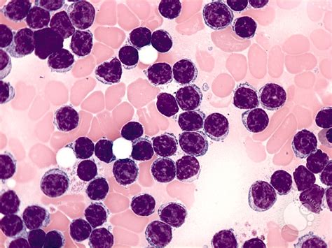 Chronic Lymphocytic Leukemia 2