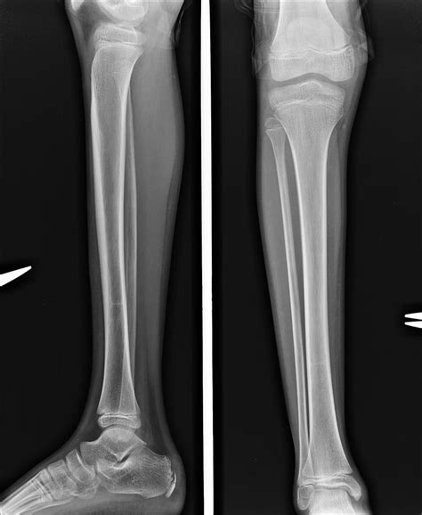 X Ray Leg