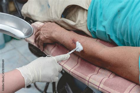 A Healthcare Provider Cleans A 3 Day Old Laceration Of Patient Caused