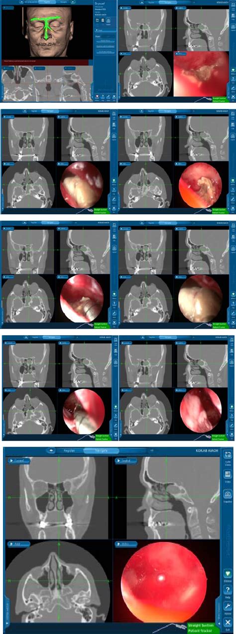 Figure 1 From Solitary Fungus Ball Of The Sphenoid Sinus Semantic Scholar