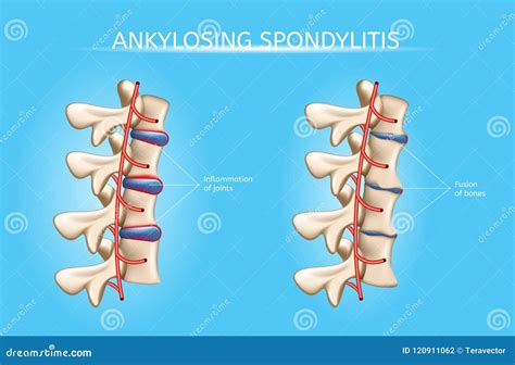 Spine Joints Arthritis Symptoms Vector Infographic | CartoonDealer.com #120911062