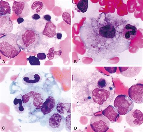 Macrophage Activation Syndrome Clinical Tree