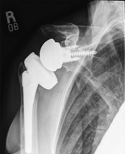 True Anteroposterior Plain Radiograph Of The Comprehensive Reverse