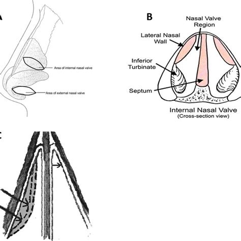 Update On The Evaluation And Management Of Nasal Valve Collapse