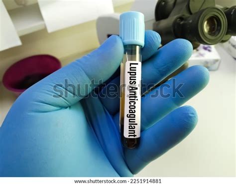 Blood Sample Lupus Anticoagulant La Blood Stock Photo 2251914881 ...