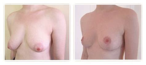 Ptose Mammaire Le Lifting Des Seins Tombants Avec Et Sans Implant Paris