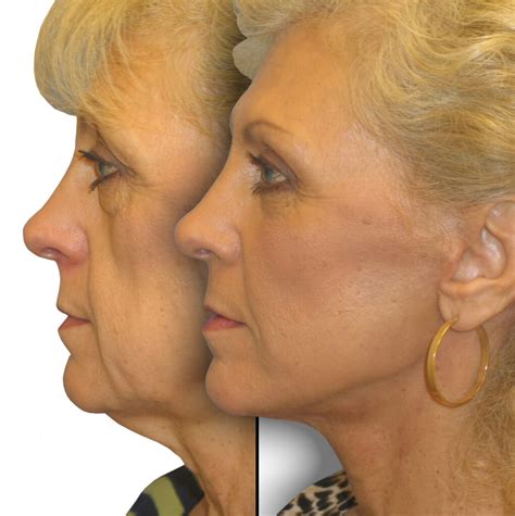 Cheek Lift In Beverly Hills Ca Dr Jason Diamond