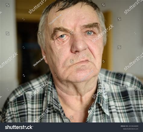 Bell S Palsy Over Royalty Free Licensable Stock Photos Shutterstock