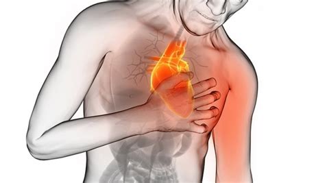 Infarto De Miocardio Qué Es Cuáles Son Sus Síntomas Y Qué Se Debe Hacer