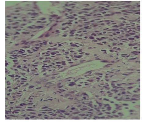 Figure 2 From Neuroendocrine Carcinoma Of Cervix And Review Literature