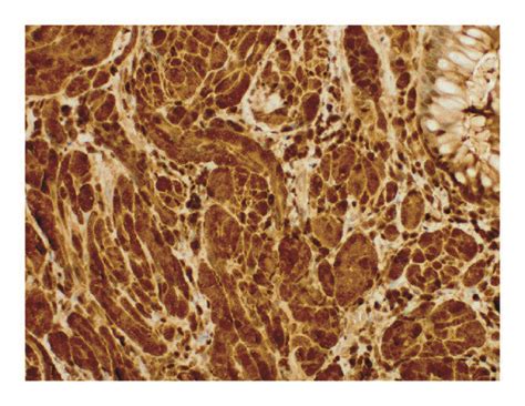 Biopsy Revealing Positive Immunohistochemical Staining For S 100