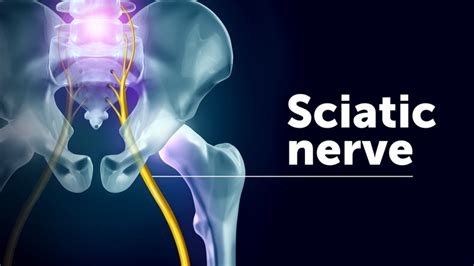 Sciatica Symptoms Causes And When To Get Care Fitntip