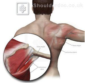 Latissimus Dorsi Transfer