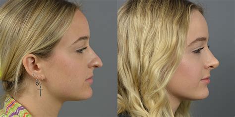 Nose Surgery Before & After Patient 37 | Dr. Marotta