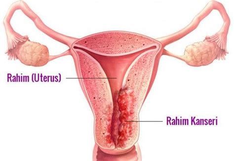 Rahim Kanseri Nedir Belirtileri Rahim Kanseri Nedenleri Tedavisi