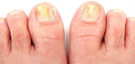 15 Disturbing Things Your Nails Reveal About Your Health Fallbrook247