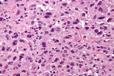 Pleomorphic Undifferentiated Sarcoma Libre Pathology