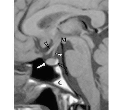 Sagittal T1 Weighted Mr Image Shows The Normal Anatomy Of The Sella