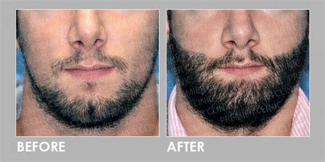 Fue Hair Transplant For Beard Premier Clinic