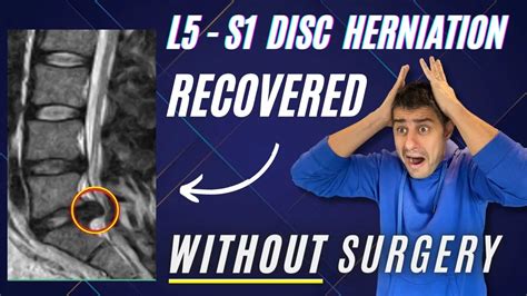 L4 L5 - L5 S1 disc herniation recovered pain free without surgery