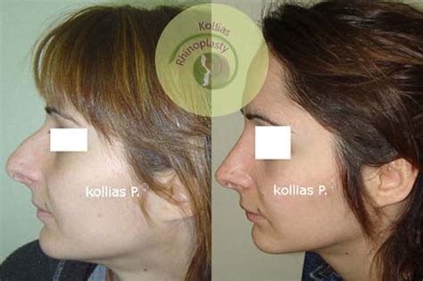 Rhinoplasty Over Development Nose 039 Π Κόλλιας