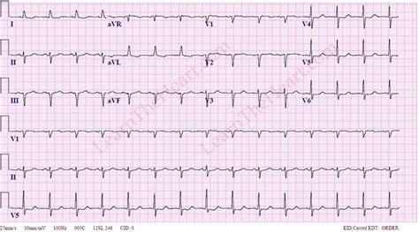 Left Anterior Fascicular Block Ecg 2