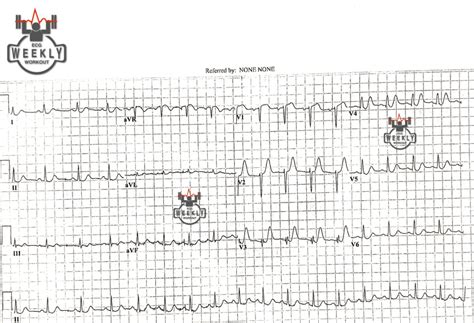 ECG Basics & Fundamentals: respect the T waves! – ECG Weekly