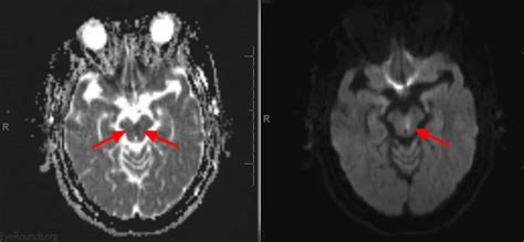 Ophthalmoplegia Internuclear And Progressive External Causes And Treatment