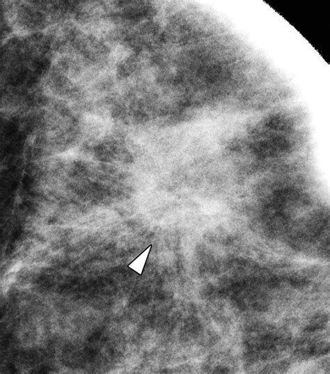 Invasive Lobular Carcinoma Of The Breast Spectrum Of Mammographic Us And Mr Imaging Findings