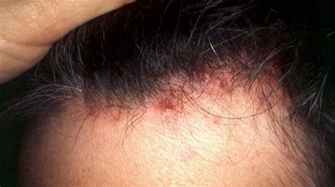 Chemical Scalp Burn How To Heal Prevent Home Remedies And More Safe Bleaching And Hair Dyeing Guide