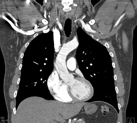 Subclavian Artery Ultrasound