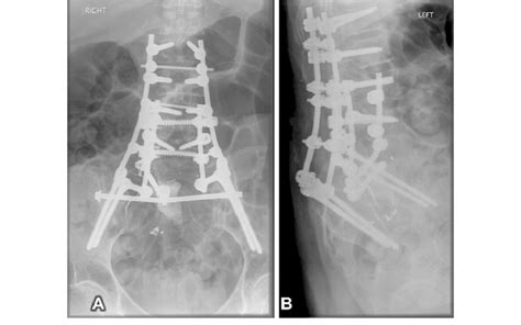 Postoperative Anteroposterior A And Lateral B Radiographs Of The