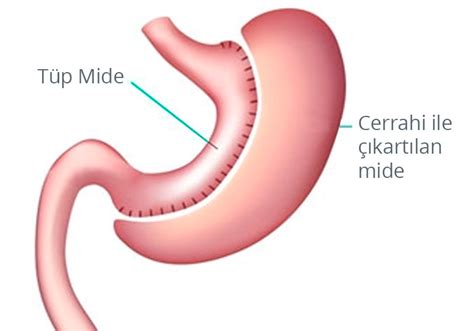 TÜP MİDE AMELİYATI