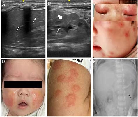 Neonatal Group B Strep Rash