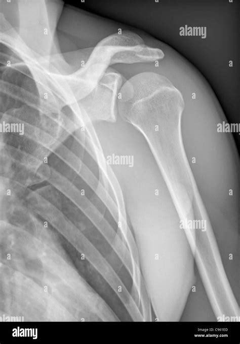 Normal Shoulder X Ray Of The Healthy Left Shoulder Of A 28 Year Old