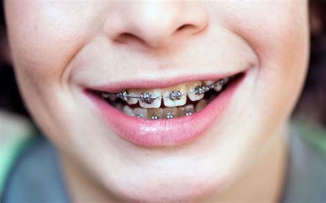 Consejos Para El Dolor De Brackets Cl Nica Dental En Toledo